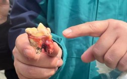 正畸拔虎牙真的有必要吗？会对牙齿和脸型有影响吗？