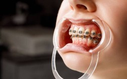 拔智齿矫正牙齿效果究竟如何？矫正效果会更好吗？