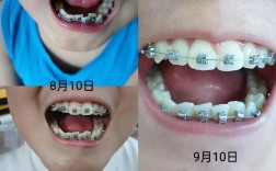 牙齿矫正第一次复诊要注意啥？流程和感受是怎样的？