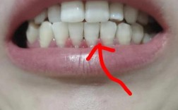 正畸之后门牙缝有黑点，是什么原因导致的？