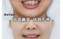 牙齿前突正畸真实案例，矫正后脸型变化明显吗？过程中有哪些关键步骤和注意事项？