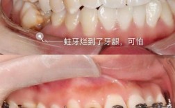 矫正牙齿为何会引发龋齿风险？