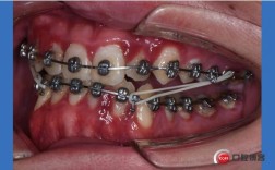 正畸带状弓是什么