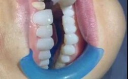 牙齿矫正美容冠是矫正牙齿还是美容修复？