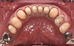 牙齿正畸为何需外科手术？效果与风险如何？