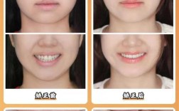 30多岁能矫正牙齿吗