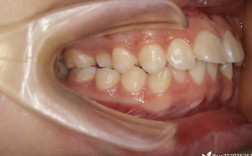 正畸拔一颗下切牙