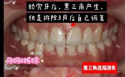 牙齿矫正后出现黑三角