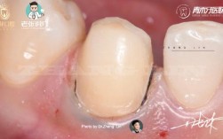 瓷贴面牙体预备方法如何选择与操作以达到最佳效果？