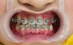 活动翼牙齿矫正效果如何？亲身经历求解答