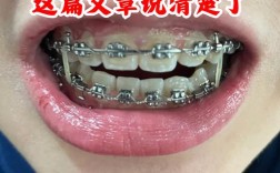 戴牙套矫正牙齿真的有效吗？效果能持久吗？