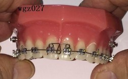 正畸直丝弓托槽是什么？矫正牙齿效果如何？