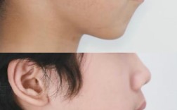 正畸对嘴巴的影响具体有哪些？