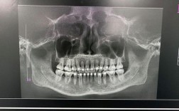 牙齿矫正会导致牙根吸收吗？风险、原因及预防方法有哪些？