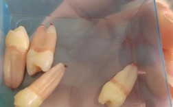 正畸治疗最多能拔几颗牙？