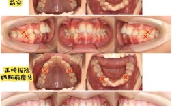 矫正牙齿，拔牙是必须的吗？