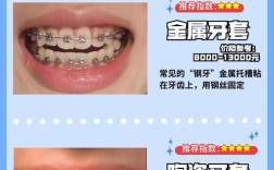 牙齿正畸牙套种类有哪些？如何挑选最适合自己的？