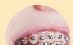 安全正畸 牙周护航