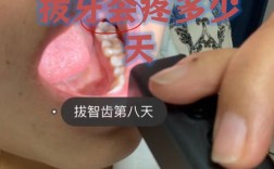 不拔牙矫正牙齿疼吗？矫正过程会痛苦吗？