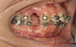 口腔正畸带环焊接视频，操作技巧与注意事项有哪些？