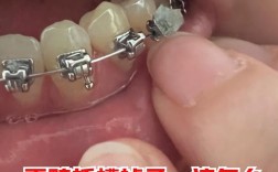 矫正器老往下掉，是粘接不牢还是佩戴不当？要紧吗？