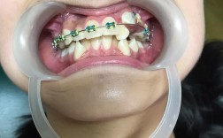 辽宁沈阳牙齿矫正