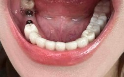 牙槽植骨后吃饭