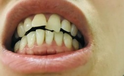 门牙不齐，哪种矫正方法最有效？如何选？