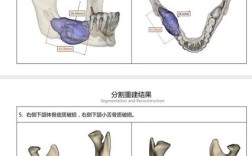 颌骨缺损重建方法如何选择？关键影响因素与临床策略是什么？