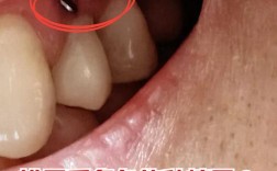 拔牙两年了可以种牙吗