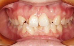 正畸后上颌中线不齐，为何会出现这种情况？