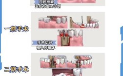 种牙对牙间距的具体要求是什么？