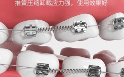 为什么矫正牙齿要戴小弹簧？它到底有什么作用？