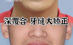 深覆合合并TMD，正畸治疗有效果吗？