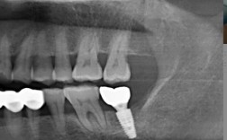 嘉兴种牙去哪儿好？靠谱医院医生怎么选？