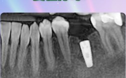 种牙前需要拍片吗