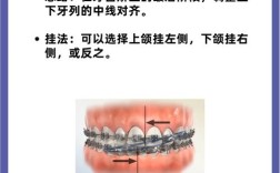 正畸治疗时橡皮筋每天需要佩戴多久？