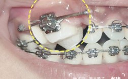 矫正牙齿金属托槽掉了怎么办？会影响矫正效果吗？