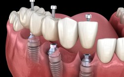 微创种植牙图片大全能展示哪些关键信息？