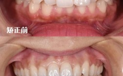 正畸前后X光对比，牙齿骨骼有何变化？