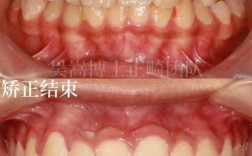 虎牙不拔牙矫正牙齿