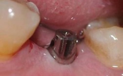 牙周炎患者种牙后，种植体能顺利长好吗？效果和持久性如何？