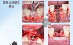 种牙后手术部位出现红肿、疼痛或出血是正常恢复表现吗？术后护理不当会引发哪些并发症？