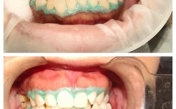 牙齿美白方法对比，哪种最有效又安全？