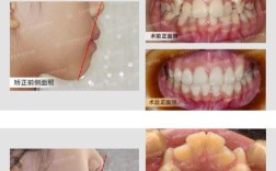 上门牙缺一个，正畸能修复好吗？