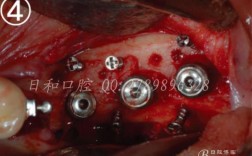 种牙植体后打钉