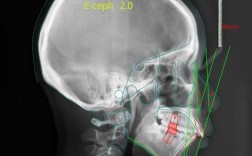 正畸头影测量视频讲座中，临床医生如何精准掌握标志点定位与数据分析的核心技巧？
