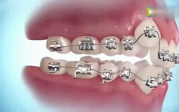 牙齿矫正全过程图片有哪些关键步骤？