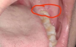 正畸后智齿突然萌出，是巧合还是另有原因？