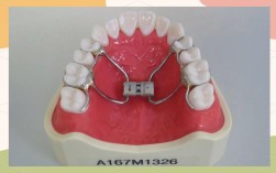 正畸新型扩弓器